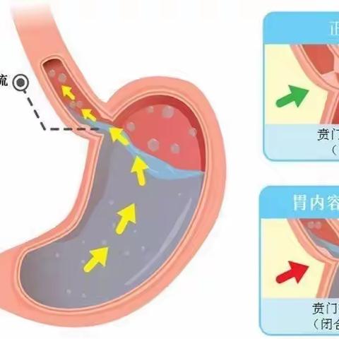 胃食管反流健康宣教