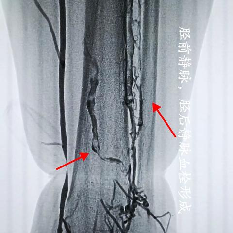 我院血管介入科完成一例高难度下肢深静脉血栓形成的一站式治疗