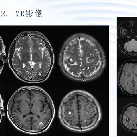 误为海绵状血管瘤的一种罕见疾病-心脏粘液瘤脑转移