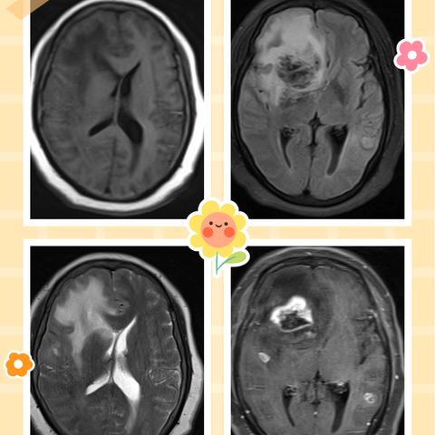 易被误认为脑转移瘤的病灶-多发胶质母细胞瘤
