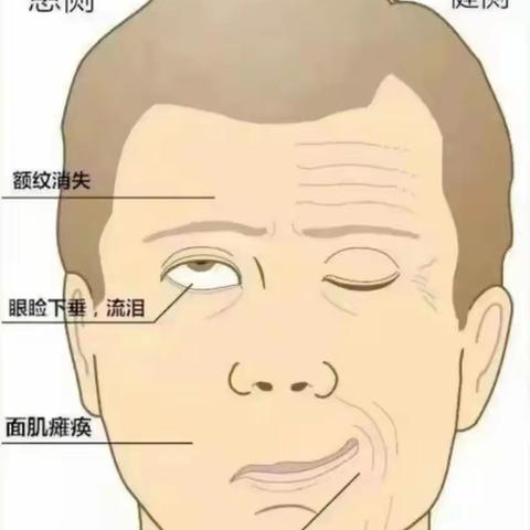 【医聊科普】面神经炎不要怕，高压氧助力恢复美丽笑容
