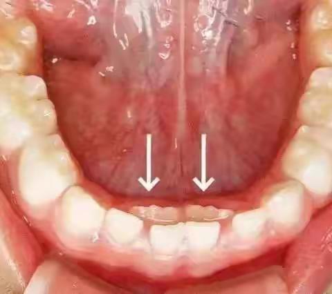 大人们喂出来的“双排牙”