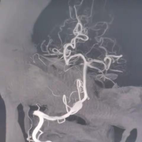 化险为夷-右侧椎动脉V4段夹层动脉瘤