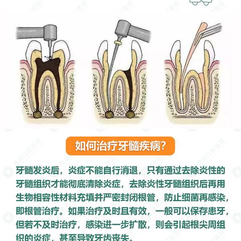 如何治疗牙髓疾病？