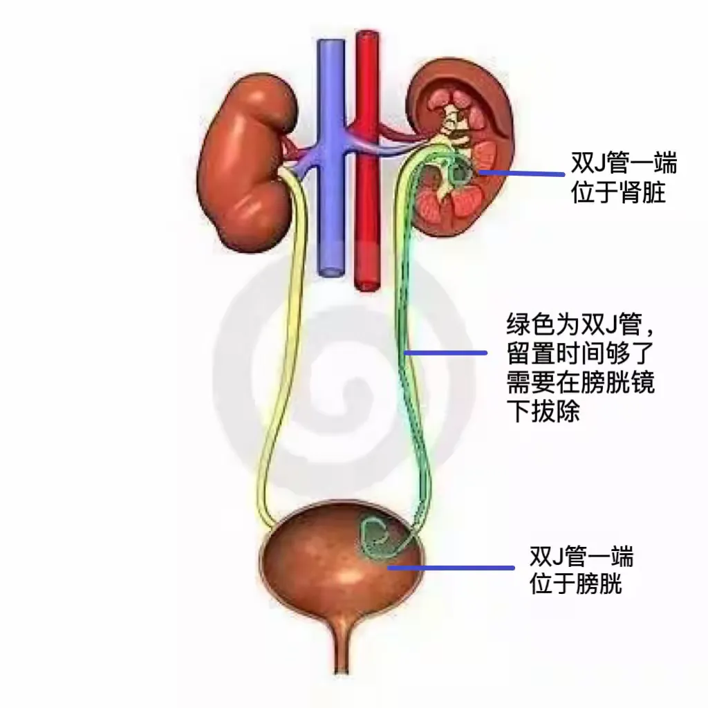 输尿管双j管置入图片图片