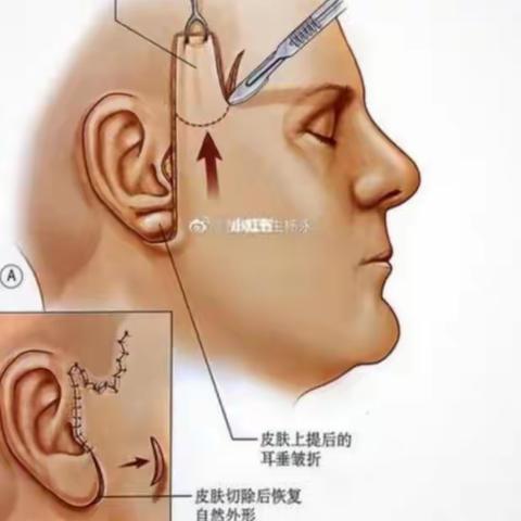 你真的知道吗小拉皮手术有什么伤害拉皮手术有什么风险和副作用