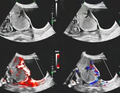 胎盘植入超声诊断病例分享