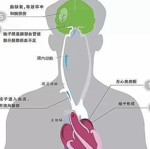 为何“中风”越来越多？都栽在这"3个字"上，不看后悔！