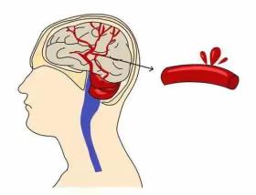 【健康科普】脑血管病的家庭预防您做到了吗？