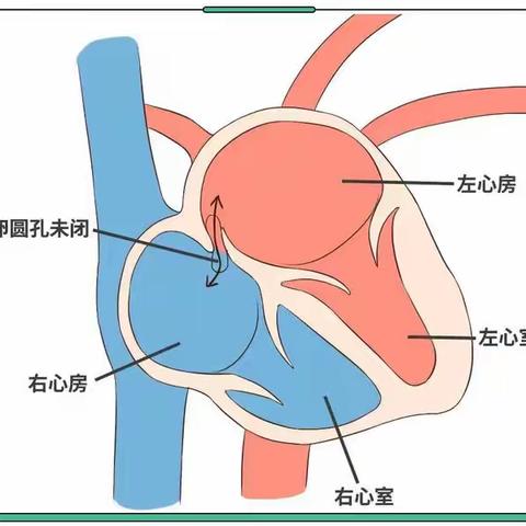 卵圆孔未闭并不可怕