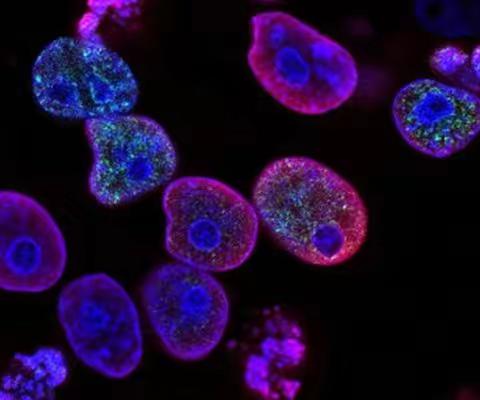 克罗恩病的干细胞疗法 ：一位美国患者的干细胞移植治疗的案例研究