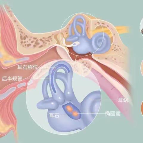 有一种天旋地转，叫“耳石症”！你知道吗？