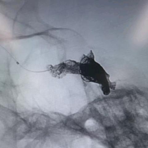 孙凤琴，女，48岁，海绵窦区DAVF。复查2024-10-08用了