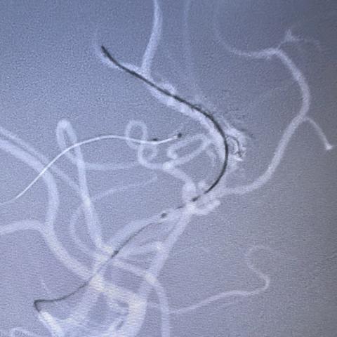 李星宇，男，18岁，动静脉畸形。复查2025-08-10