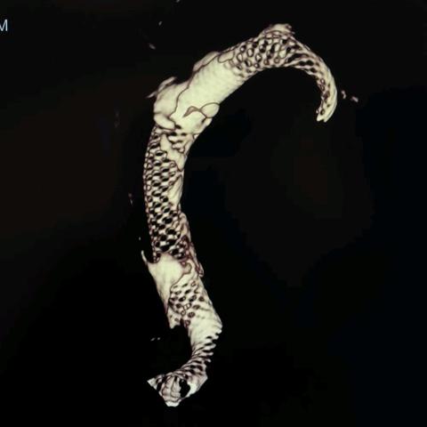 神内-椎基底动脉延长扩张-Lattice串联5.6-5.3-5.6。10-27神内刘