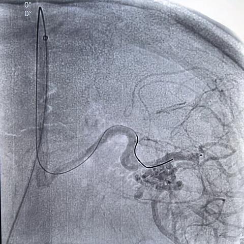 徐建国，男，45岁，额叶动静脉畸形-动静脉入路