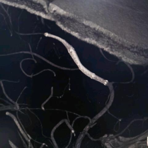 崔广超，男，36岁，大脑前动脉瘤-LVIS EVO 2.5-22&17