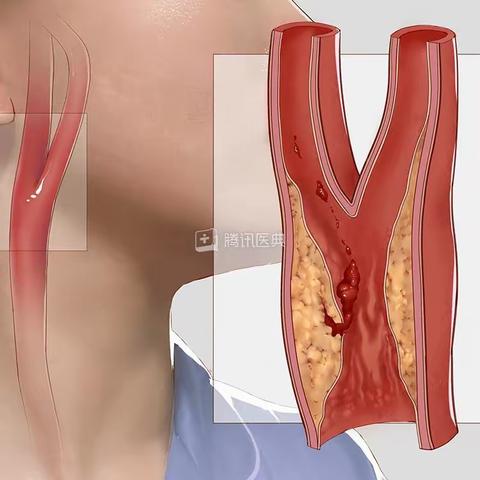 颈内动脉狭窄的手术治疗