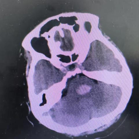 神经外一科与肾内科联合抢救脑干出血合并肾衰竭病人