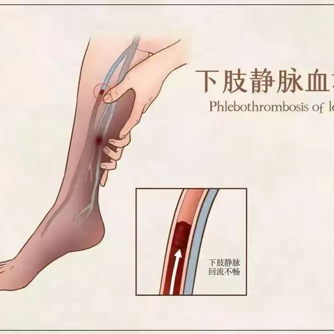 下肢深静脉血栓，藏在身体里的危险信号