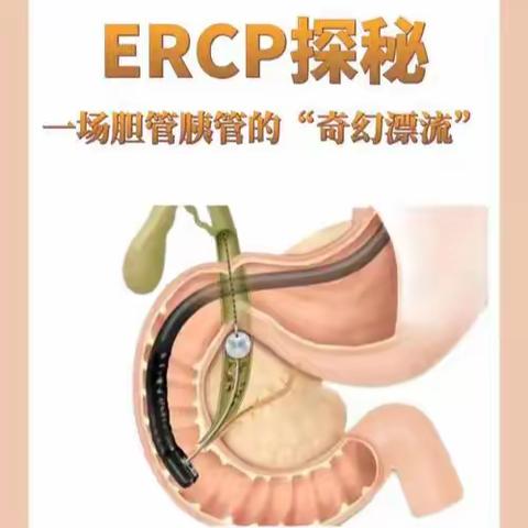 兰陵开源医院完成一例87岁高龄内镜下胆总管取石术（ERCP）