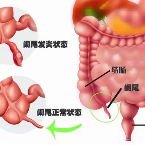 兰陵开源医院成功完成一例“子母镜”下阑尾粪石碎石+取出术