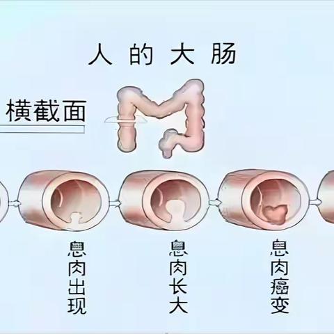 肠息肉——腹腔内的“定时炸蛋”，特别是这四种要重视，癌变率高！