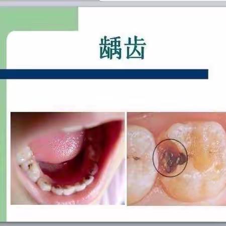 《关爱牙齿，预防龋齿》——能量娃幼儿园龋齿预防宣传