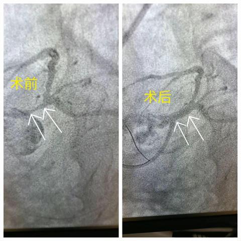 血管内超声(IVUS)——心内科的“火眼金睛