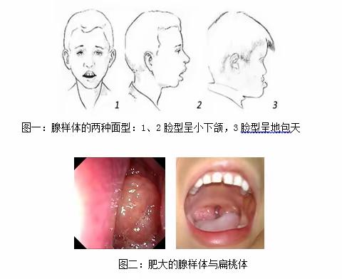儿童扁桃体切除术和腺样体切除术的术后护理