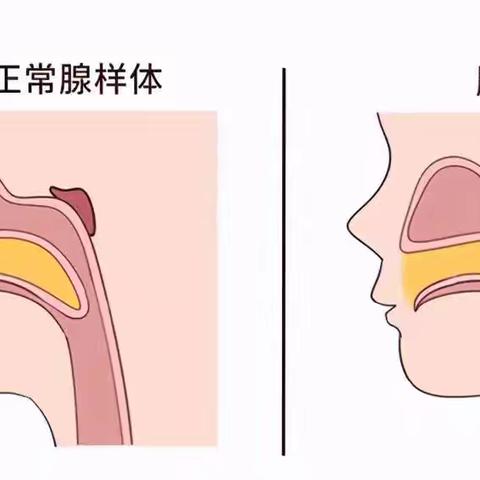 有一种变丑叫“腺样体面容”