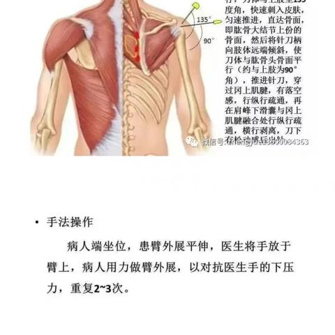 肩部疼痛的针刀诊断与治疗