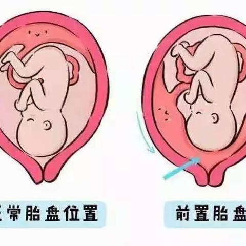 产科急危重症手术配合能力提升--完全性前置胎盘手术护理教学查房