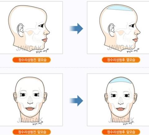 颅顶增高选择烫发能保持多久？get雕刻颅顶增高术打造头包脸效果