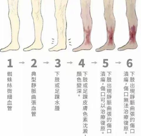 三抓三促行动进行时丨我院成功开展大隐静脉高位结扎硬化剂注射静脉剥脱术