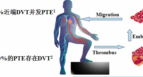 静脉血栓栓塞症（VTE）