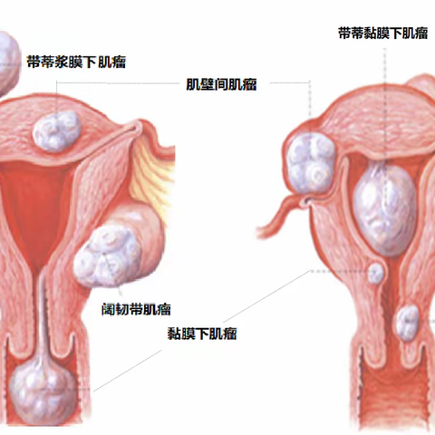 【揭秘】子宫肌瘤：女性健康的隐形杀手，你了解多少？