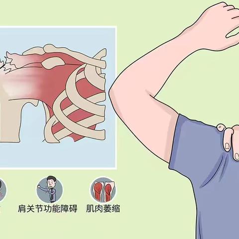 关节镜下肩袖修补术