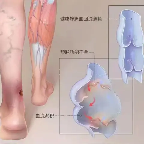 大隐静脉曲张术后复发，到底是谁的问题？