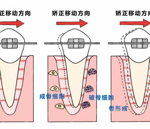 牙齿矫正会导致牙齿松动吗？