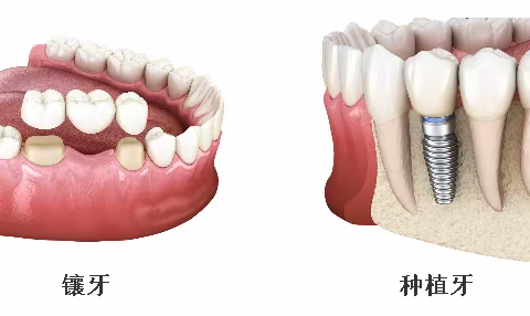 拔牙后镶牙好还是种牙好？