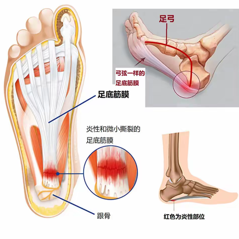 办公室“微运动”之— “千里之行，始于足下”远离足底筋膜炎