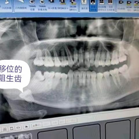 破冰之旅——我院口腔科成功取出进入翼下颌间隙的智齿