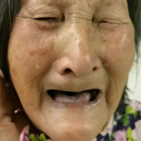 兰溪永球医院三氧-带状疱疹康复过程