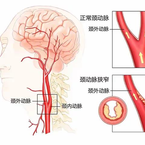 【樊灿—神内二】脑血管病一级预防科普系列之（三）