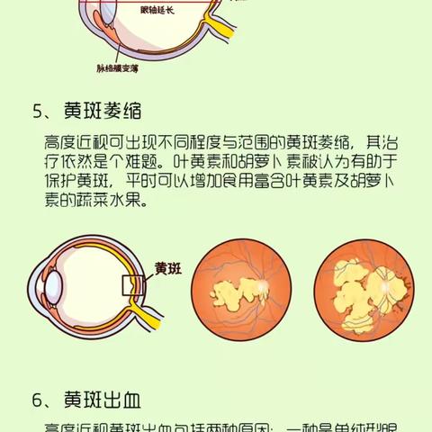 一图读懂高度近视眼底病