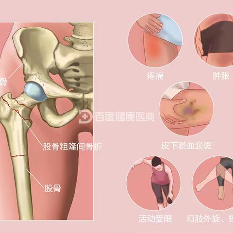 高效诊疗，优质服务 ——外一科完成一例股骨粗隆间骨折手术