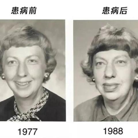 出现这 1 种面相，‍可能是肿瘤前兆！‍别以为只是变丑了
