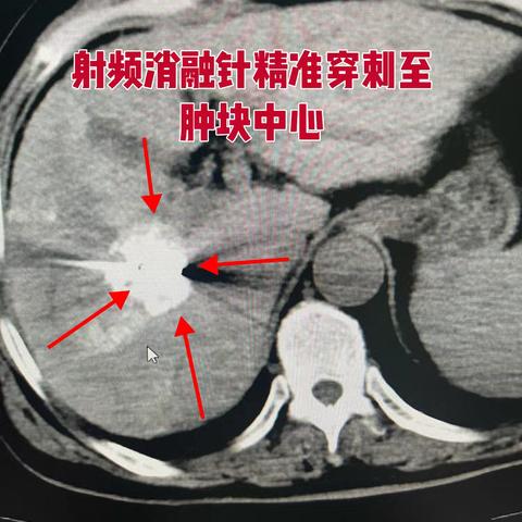 一通来自三年前高龄肝癌微波消融术后患者的来电