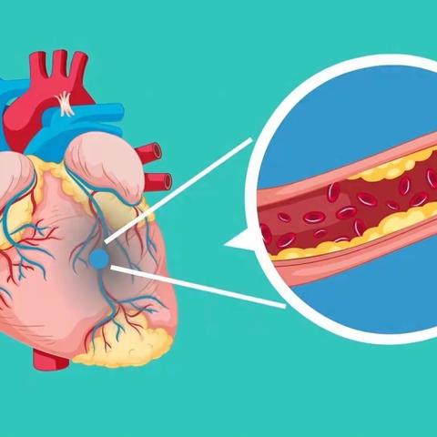 了解动脉粥样硬化